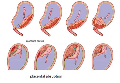 Antepartum Hemorrhage (Part 3) – Platform | CME