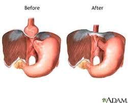 hiatal hernia surgery | hiatal hernia surgery recovery diet | Hernia exercises, Natural ...