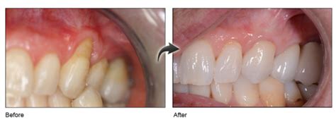 Gum Recession Treatment Near Me- Chao Pinhole Surgery - Gum Disease