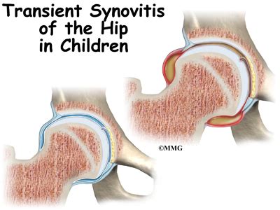 Transient Synovitis - eOrthopod.com