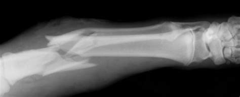 Osteogenesis imperfecta (brittle bone disease) | Healthengine Blog