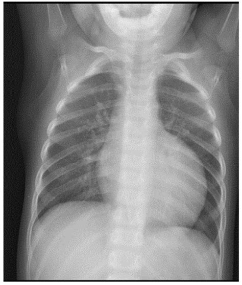 Chest X-ray showing severe cardiomegaly. | Download Scientific Diagram