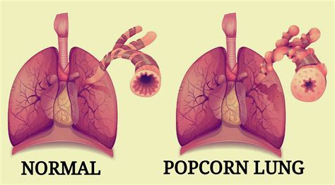 Image result for popcorn lung | Popcorn, Lunges, Movie posters