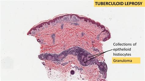 LEPROSY- Tuberculoid & Lepromatous - Pathology Made Simple