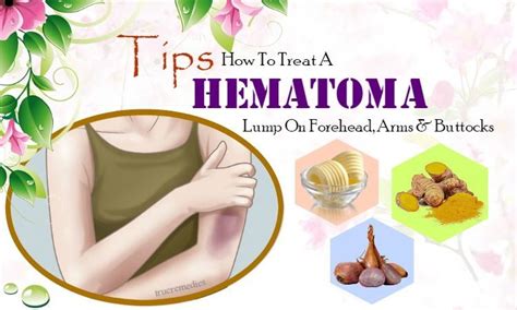 23 Tips How To Treat A Hematoma Lump On Forehead, Arms & Buttocks