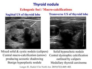 Ultrasound of thyroid nodules | PPT