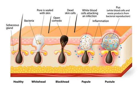 Boil vs Pimple- Differences with Pictures, Boil or Pimple?