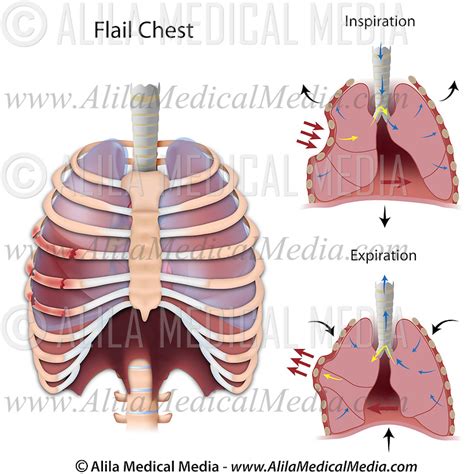 Paradoxical Breathing