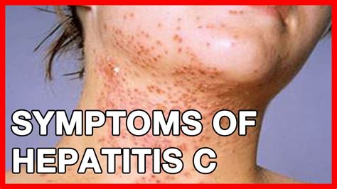 What is Hepatitis C? Is it a STD? Transmission, vaccine and Symptoms - YouTube