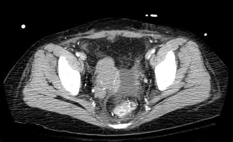 Intravenous leiomyomatosis - wikidoc