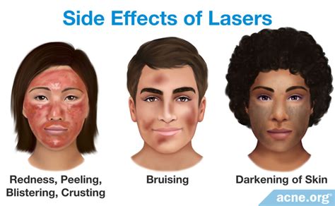 Lasers and Acne - Acne.org