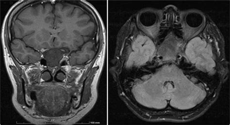 Coronal T1 image showing the expansion of the clivus with heterogeneous... | Download Scientific ...