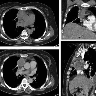 The CT scan of the mass (arrow) in the anterior mediastinum. (A) It is ...