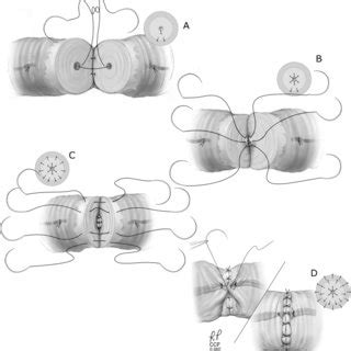 Modified two-layer vasovasostomy. | Download Scientific Diagram