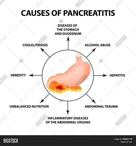 Causes Pancreatitis. Image & Photo (Free Trial) | Bigstock