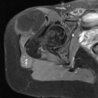 (PDF) Hydrocele of the canal of Nuck: Ultrasound and MRI findings