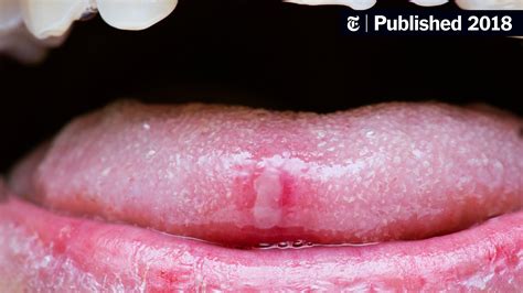 Cold Sores In Back Of Mouth