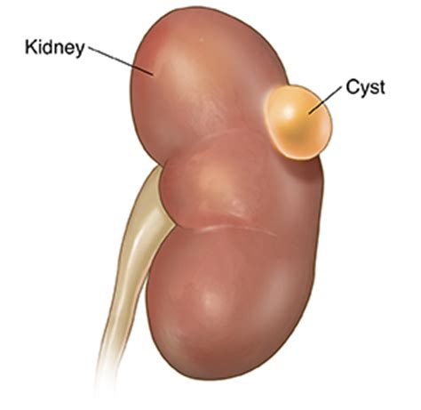 Simple Kidney Cysts | Saint Luke's Health System