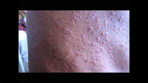 Sweat Rash (Miliaria Profunda) - YouTube