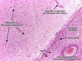 Histology and Explanation of Purulent Meningitis | MEDICAL CHOICES