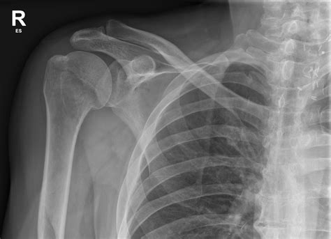 Left Humerus Fracture Radiograph Of The Left Humerus Shows An