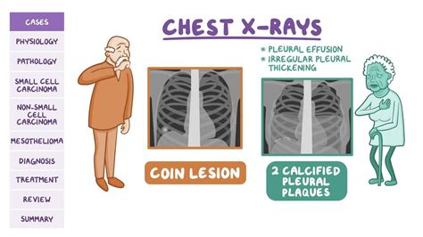 How To Treat Stage 2 Copd