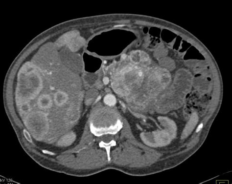 Neuroendocrine Tumor of the Pancreas with Liver Metastases - Pancreas Case Studies - CTisus CT ...