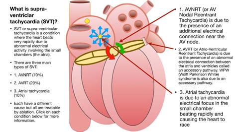 Supra Ventricular Tachycardia (SVT) Ablation - Bayside Heart