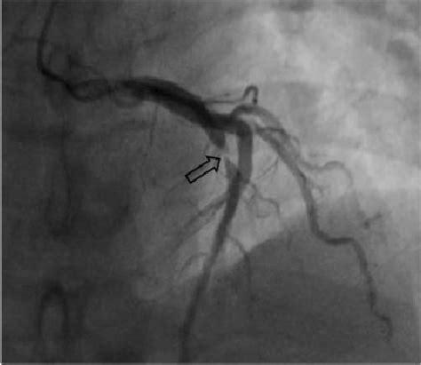 Figure 2 from A case of de Winter syndrome presenting with chest ...