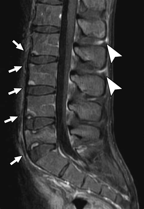 Ankylosing Spondylitis Mri