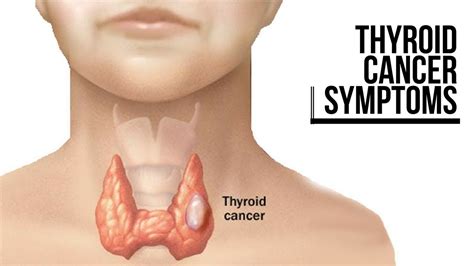 THYROID CANCER SYMPTOMS - YouTube