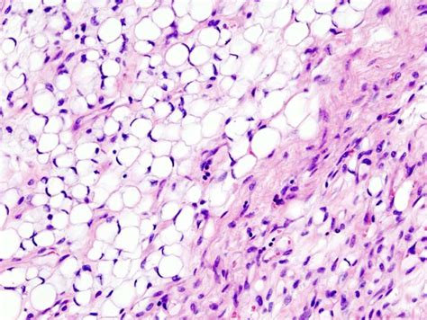 File:Myxoid liposarcoma (01).jpg - Wikipedia