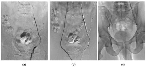 Example of typical bilateral varicocele embolization (VE) procedure... | Download Scientific Diagram