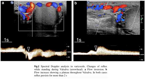 EVALUASI VARICOCELE ULTRASOUND – radiologi.id