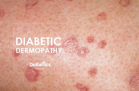 Diabetic Dermopathy – An Overview – Diabetes Blog | Diabetes, Paw print tattoo, Paw print