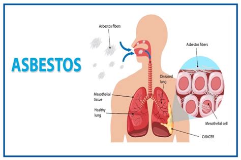 Understanding Asbestosis: Causes, Symptoms, And Treatment - Ask The ...