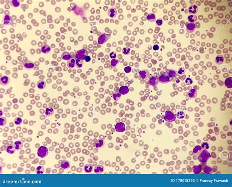 Blood Smear Leukemia Stock Photo Image Of Microscopy | My XXX Hot Girl