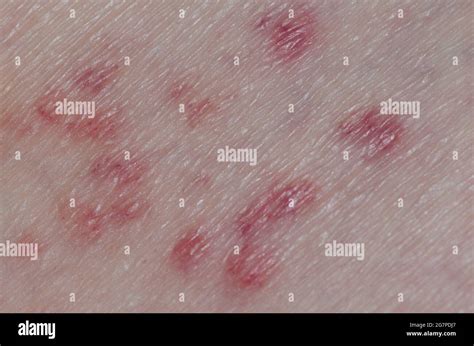 Rash on human skin due to chiggers, Family Trombiculidae Stock Photo - Alamy