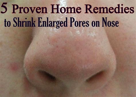 5 Proven Home Remedies to Shrink Enlarged Pores on Nose | Nose pores, Shrink pores on nose ...