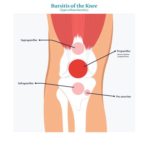 Knee Bursitis: All You Need to Know - Centeno-Schultz Clinic