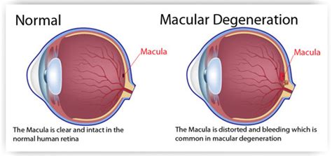 Macular degeneration (AMD) | Epping Surgery Centre