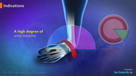 Ankle Instability Surgery Video | YPO Education