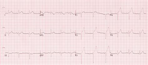 Differentiating normal early ST repolarization versus left anterior STEMI – PEMBlog