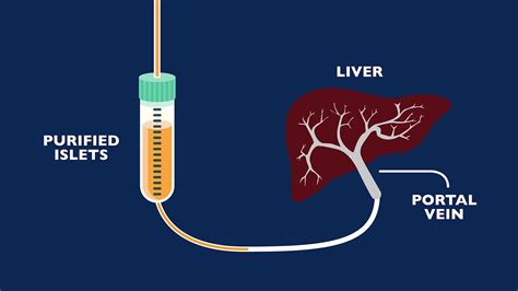 Auto Islet Transplant Program - YouTube