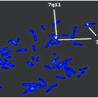 FISH technique shows microdeletion of 7q11.23 containing the Elastin ...