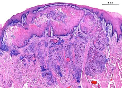 Squamous Cell Carcinoma Of The Tongue Photograph by Jose Calvo/science ...