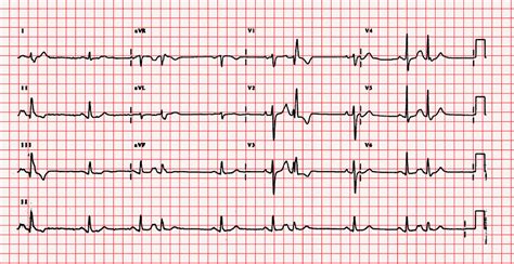 tranzistor časopis akadémie ventricular premature beats usmievať ...