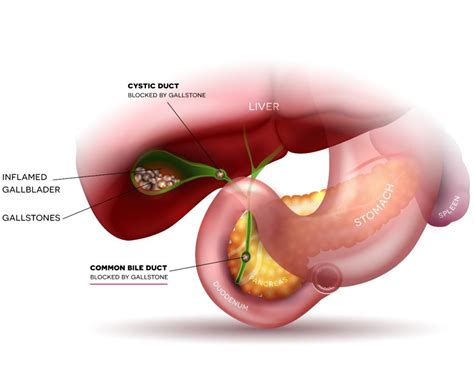 Bile Duct Stones Symptoms and Treatment | Nexus Surgical