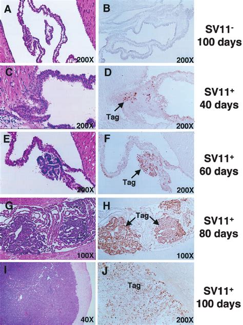 Progression of choroid plexus tumors in unmanipulated SV11 ϩ mice ...