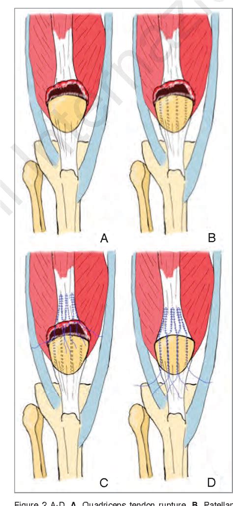 Quadriceps Muscle Tear